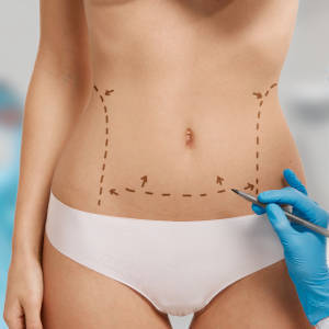 cirujano-plastico-de-centro-pylus-xativa-marca-a-paciente-femenino-semidesnuda-en-abdomen-para-cirugia-plastica-y-reparadora-en-xativa