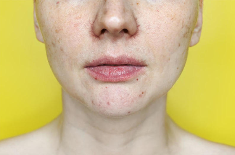 rostro-de-mujer-en fondo-amarillo-con-afecciones-de-la-piel